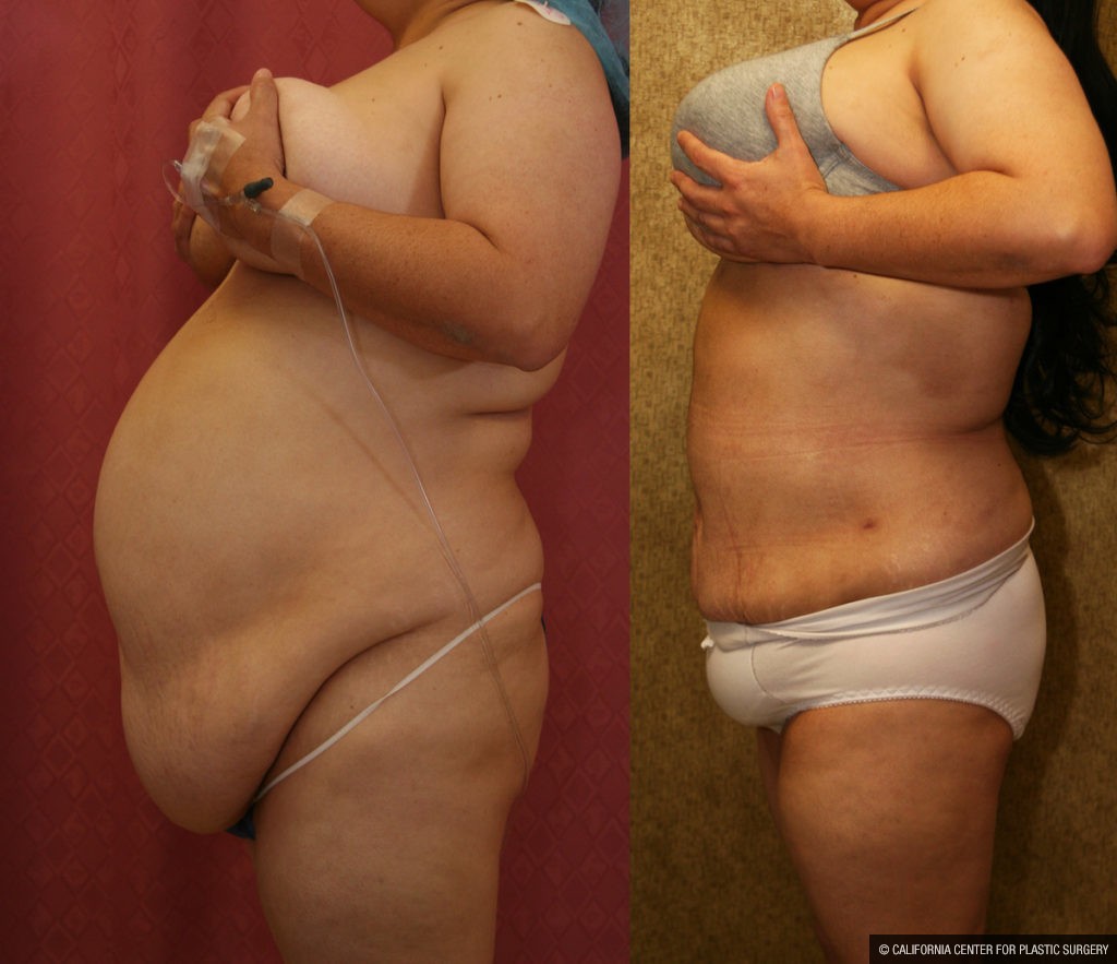 Liposuction Abdomen Plus Size Before & After Patient #13529