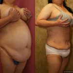 Liposuction Abdomen Plus Size Before & After Patient #13529