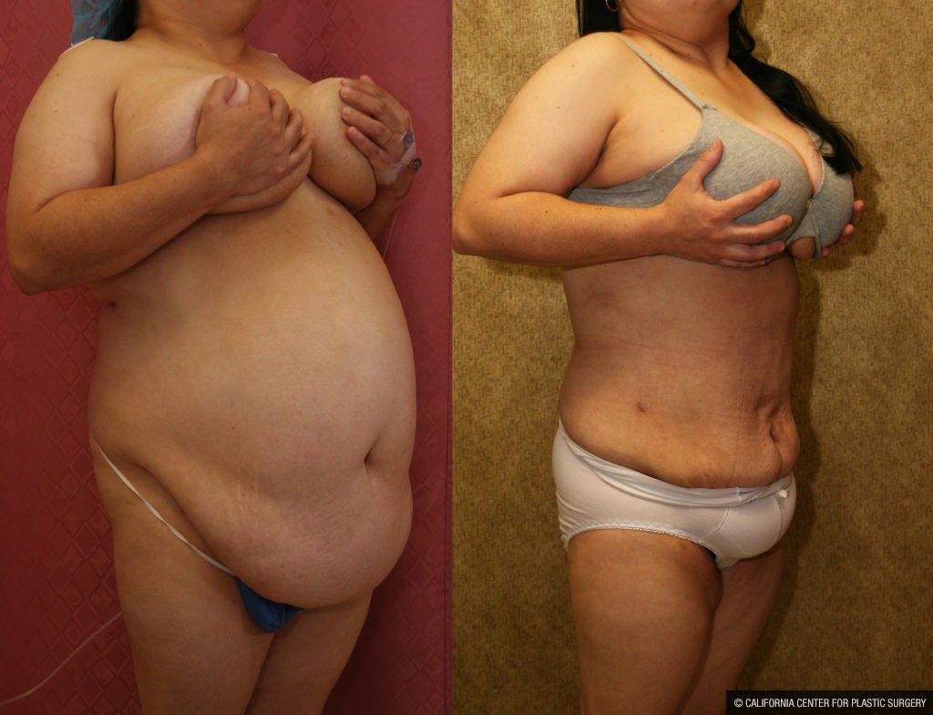 Liposuction Abdomen Plus Size Before & After Patient #13529