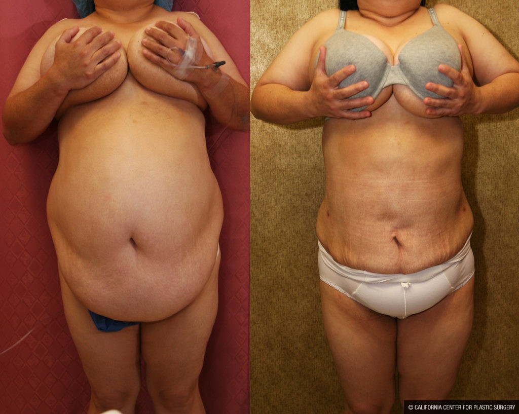 Liposuction Abdomen Plus Size Before & After Patient #13529