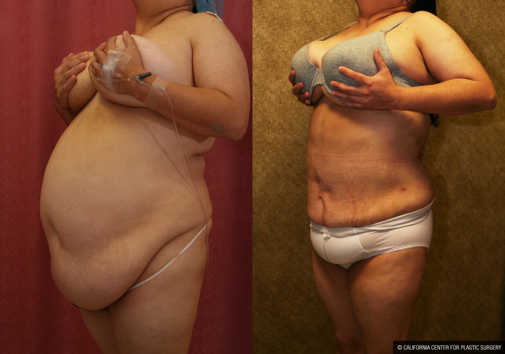 Liposuction Abdomen Plus Size Before & After Patient #13529