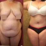 Tummy Tuck (Abdominoplasty) Super Plus Size Before & After Patient #13621