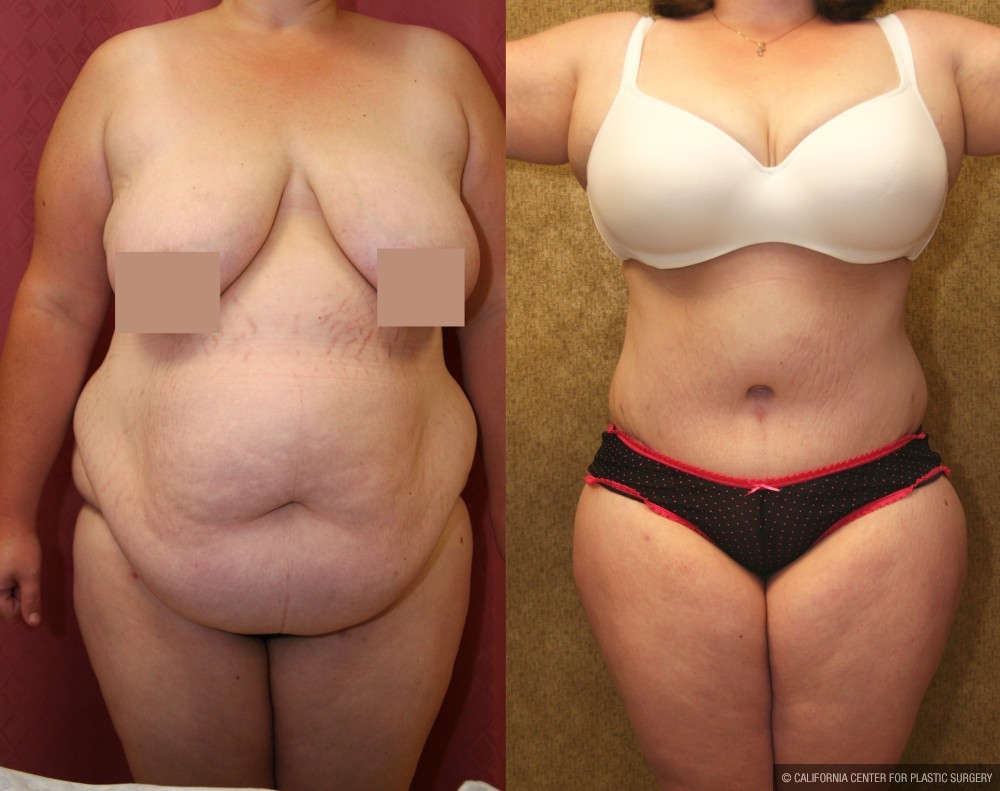 Tummy Tuck (Abdominoplasty) Super Plus Size Before & After Patient #13621