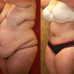 Tummy Tuck (Abdominoplasty) Super Plus Size Before & After Patient #13621