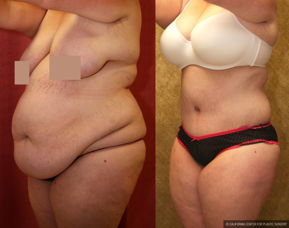 Tummy Tuck (Abdominoplasty) Super Plus Size Before & After Patient #13621