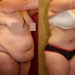 Tummy Tuck (Abdominoplasty) Super Plus Size Before & After Patient #13621