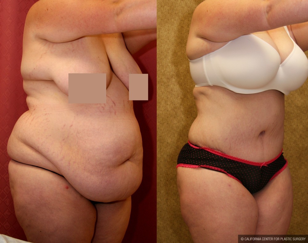 Tummy Tuck (Abdominoplasty) Super Plus Size Before & After Patient #13621