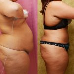 Liposuction Abdomen Plus Size Before & After Patient #13534
