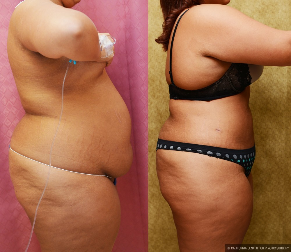 Liposuction Abdomen Plus Size Before & After Patient #13534