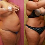 Liposuction Abdomen Plus Size Before & After Patient #13534