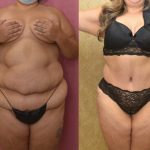 Tummy Tuck (Abdominoplasty) Super Plus Size Before & After Patient #13633