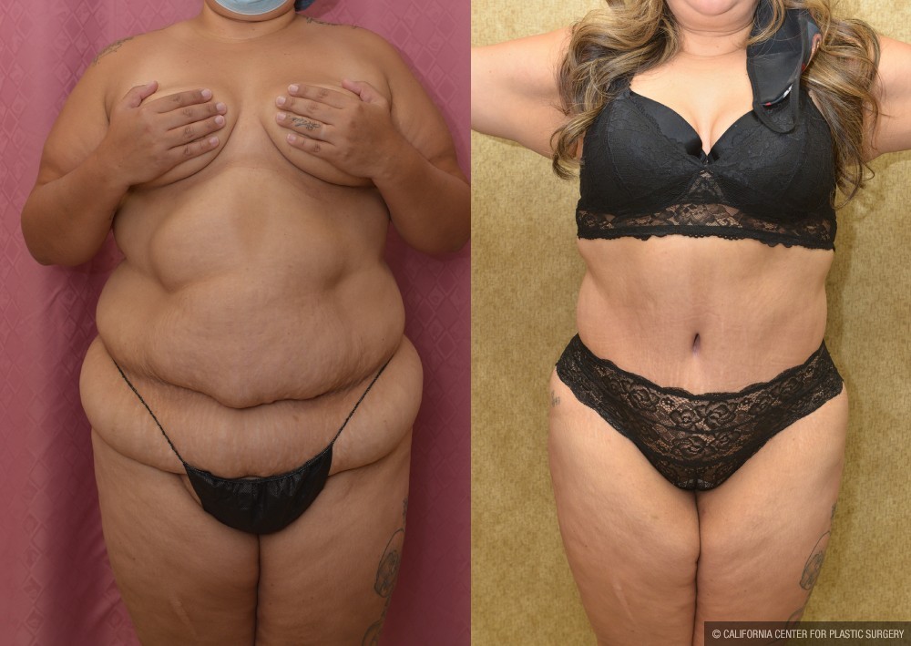 Tummy Tuck (Abdominoplasty) Super Plus Size Before & After Patient #13633