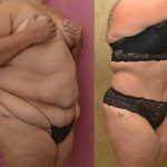 Tummy Tuck (Abdominoplasty) Super Plus Size Before & After Patient #13633