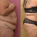 Tummy Tuck (Abdominoplasty) Super Plus Size Before & After Patient #13633