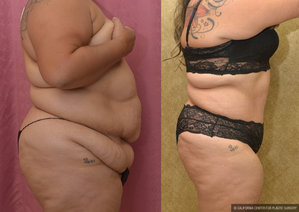 Tummy Tuck (Abdominoplasty) Super Plus Size Before & After Patient #13633