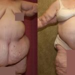 Tummy Tuck (Abdominoplasty) Super Plus Size Before & After Patient #13625