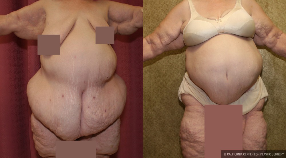 Tummy Tuck (Abdominoplasty) Super Plus Size Before & After Patient #13625