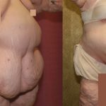 Tummy Tuck (Abdominoplasty) Super Plus Size Before & After Patient #13625