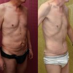 Male Tummy Tuck (abdominoplasty) Before & After Patient #13574