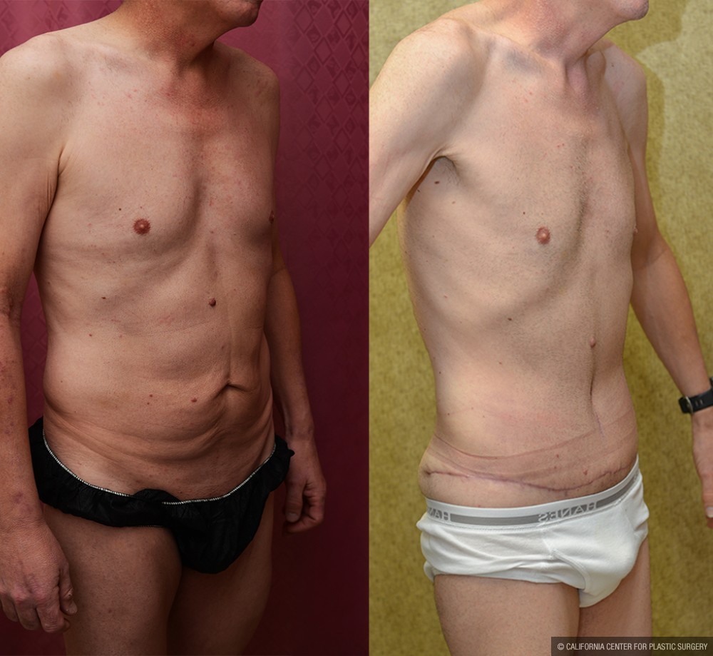 Male Tummy Tuck (abdominoplasty) Before & After Patient #13574