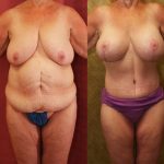 Mommy Makeover Before & After Patient #13588