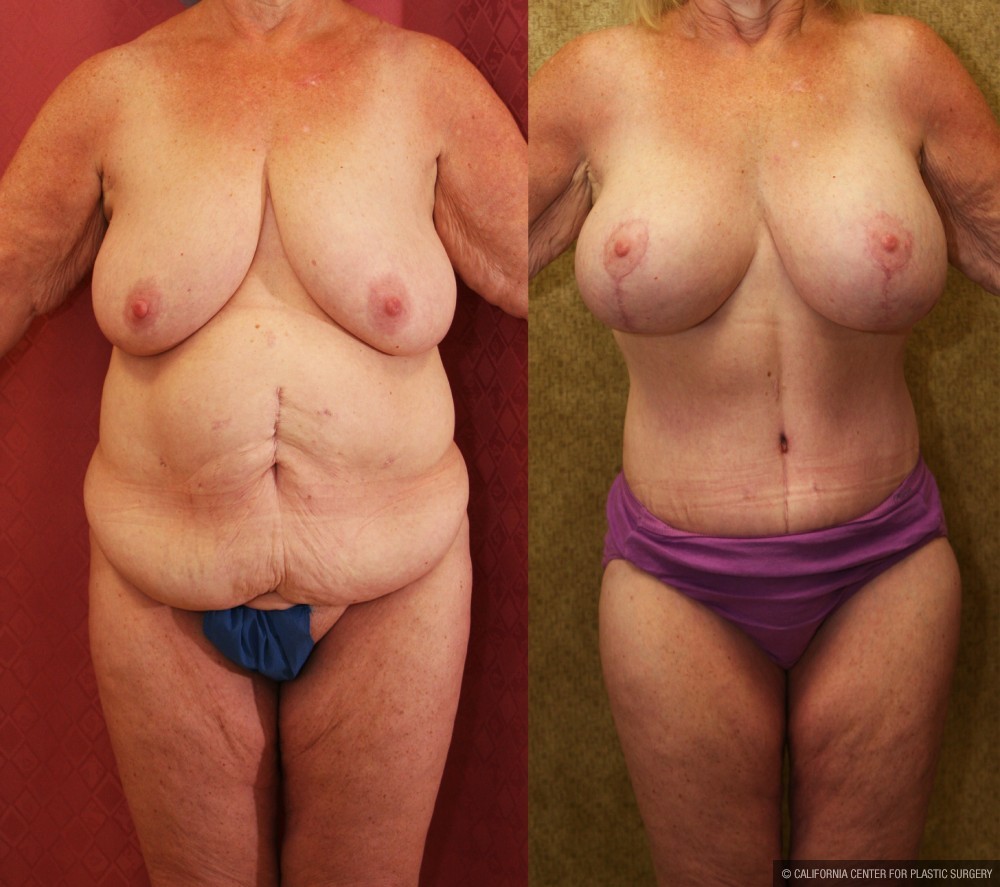 Mommy Makeover Before & After Patient #13588