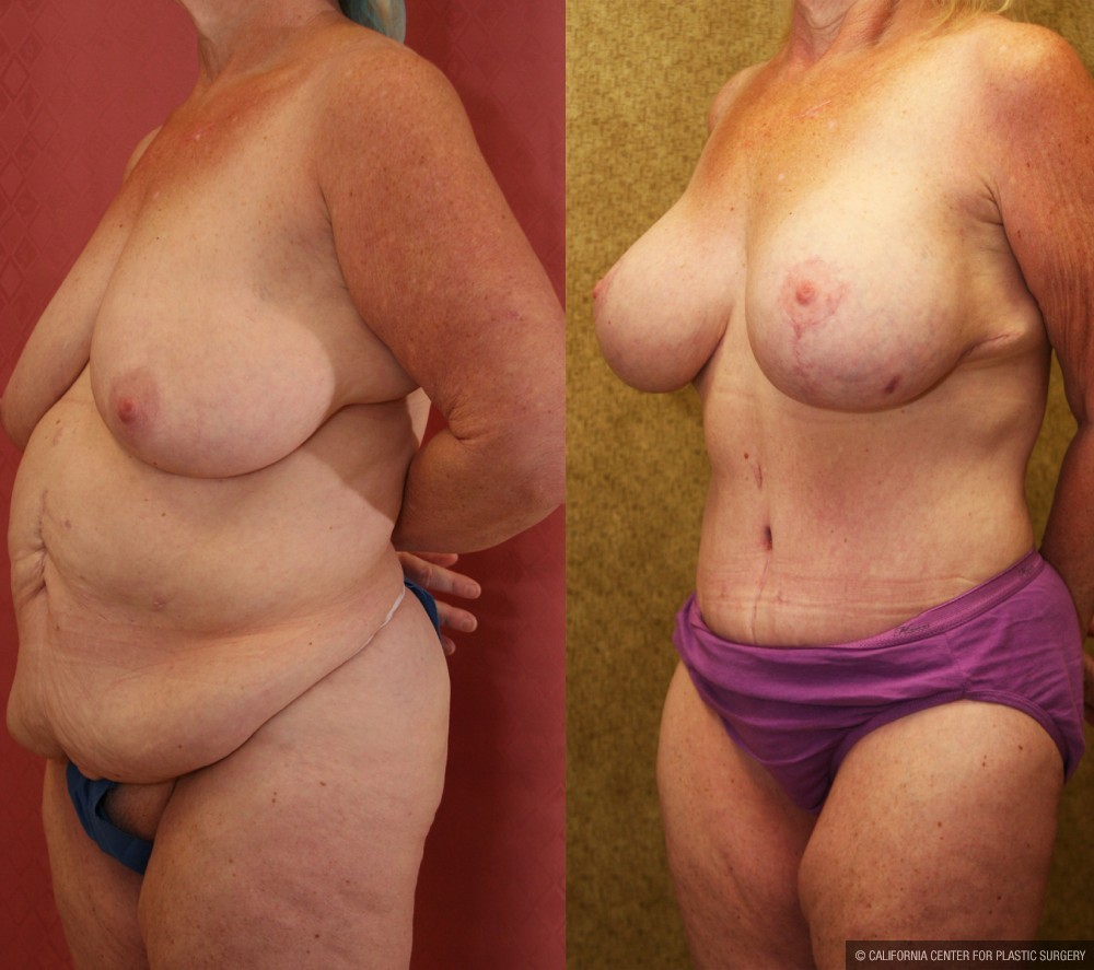 Mommy Makeover Before & After Patient #13588