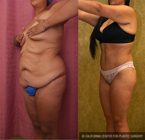 Body Lift Before & After Patient #13815