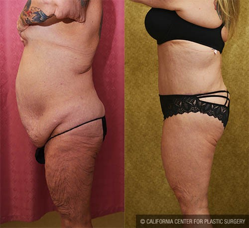Body Lift Before & After Patient #13808