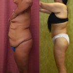 Body Lift Before & After Patient #13815