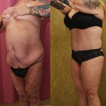Body Lift Before & After Patient #13808