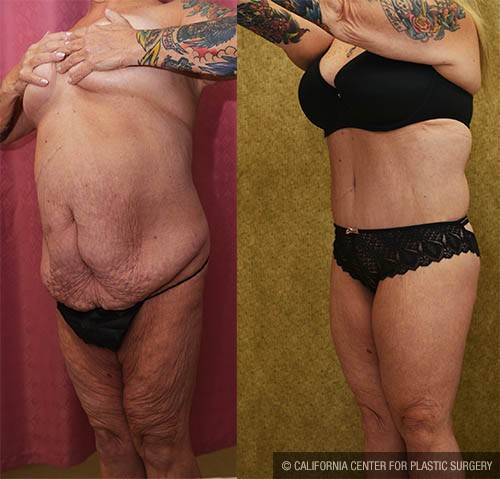 Body Lift Before & After Patient #13808