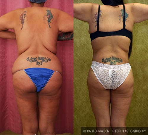 Body Lift Before & After Patient #13815