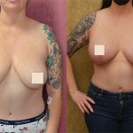 Breast Augmentation Before & After Patient #13814