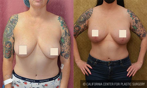 Breast Augmentation Before & After Patient #13814