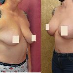 Breast Augmentation Before & After Patient #13814