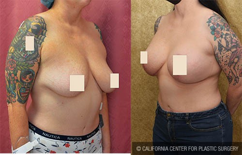 Breast Augmentation Before & After Patient #13814