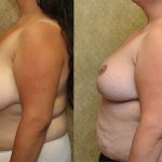 Breast Reduction Before & After Patient #13816