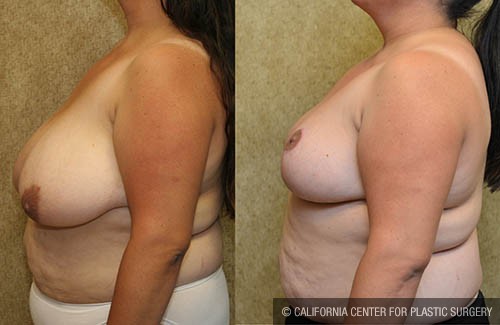 Breast Reduction Before & After Patient #13816