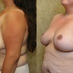 Breast Reduction Before & After Patient #13816