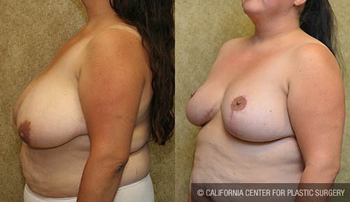 Breast Reduction Before & After Patient #13816