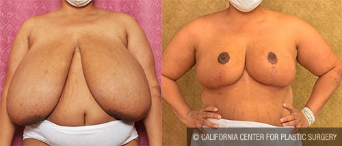 Breast Reduction Before & After Patient #13685