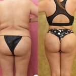 Liposuction of Buttocks Before & After Patient #13687