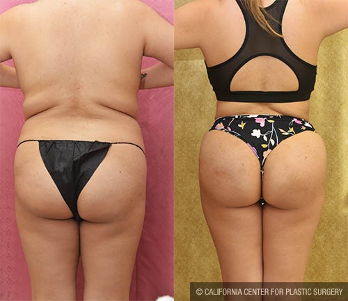 Liposuction of Buttocks Before & After Patient #13687