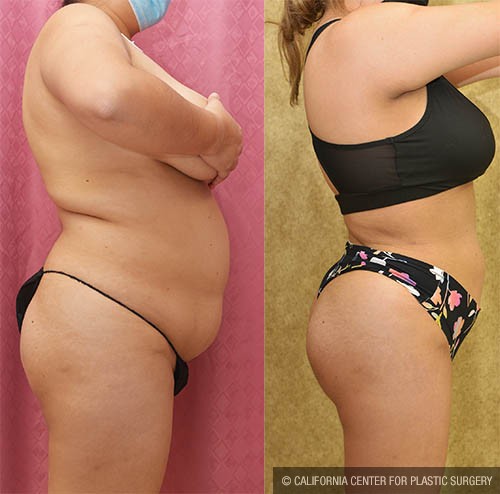 Body Lift Before & After Patient #13817