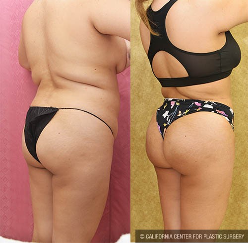 Liposuction of Buttocks Before & After Patient #13687