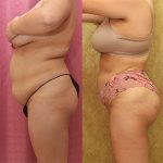 Liposuction of Buttocks Before & After Patient #13688