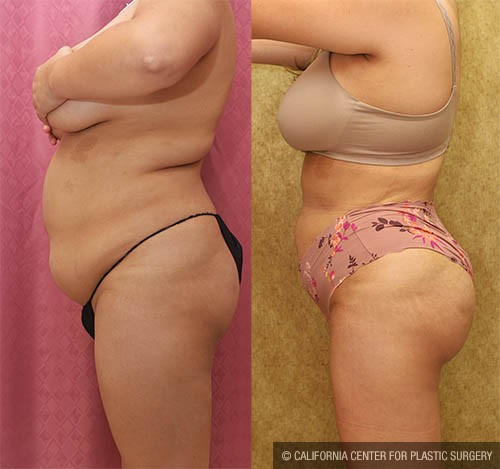 Liposuction of Buttocks Before & After Patient #13688