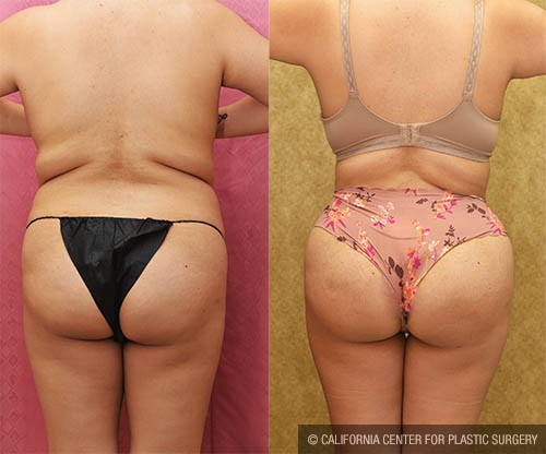 Liposuction of Buttocks Before & After Patient #13688