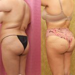 Liposuction of Buttocks Before & After Patient #13688